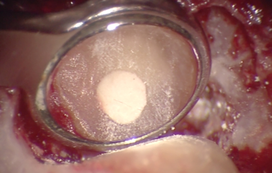 Obr. 1.3: Retrográdní výplň bílým MTA.