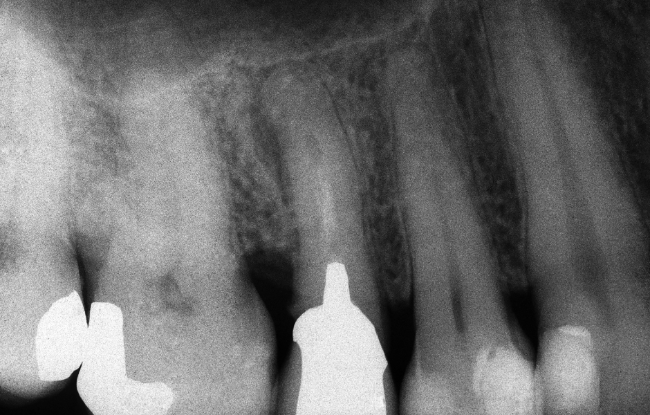 Obr. 2.1: Předoperační rentgenový snímek horního pravého druhého moláru. Je patrná drobná laterální radiolucence indikující přítomnost laterálního kanálku.