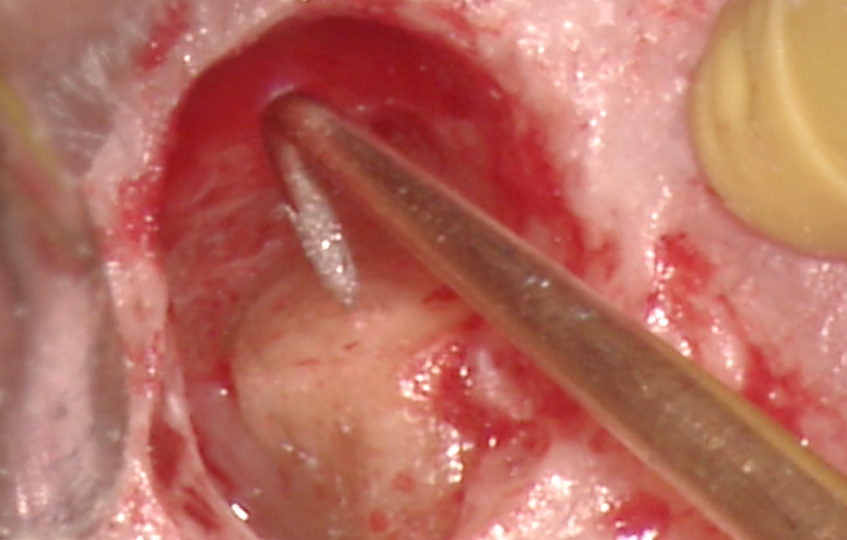 Obr. 2.5: Ultrazvukový nástroj při preparaci dutiny v hlavním kořenovém kanálku.