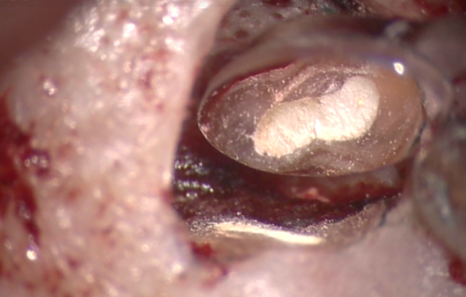 Obr. 4.3: Retrográdní výplň MB1, MB2 a isthmu.