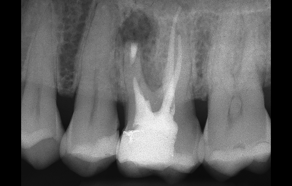 Obr. 4.4: Pooperační rentgenový snímek zobrazující retrográdní výplň z bílého MTA.