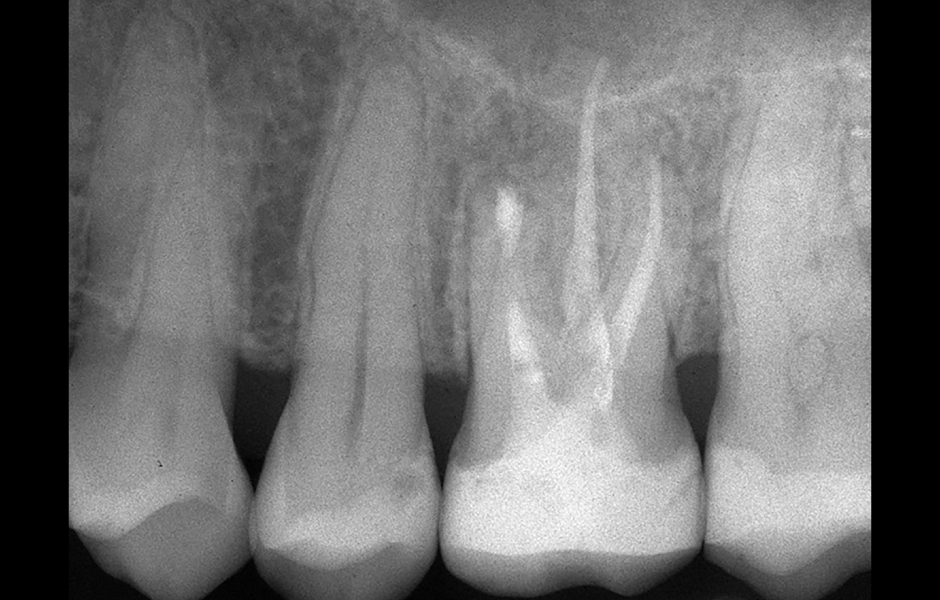 Obr. 4.6: Kontrola po třech letech se zhojením léze.