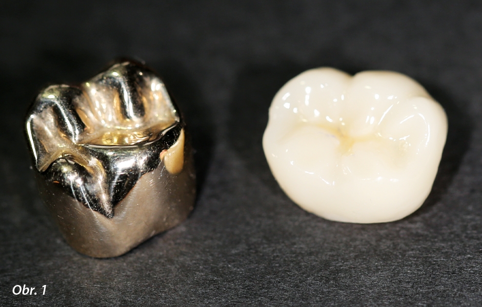 Tradiční zlaté korunky (vlevo) a metalokeramické korunky je možno konvenčně nacementovat (např. zinkfosfátem) a mají vynikající míru zachování in situ blížící se až 50 letům. (literatura 1) 