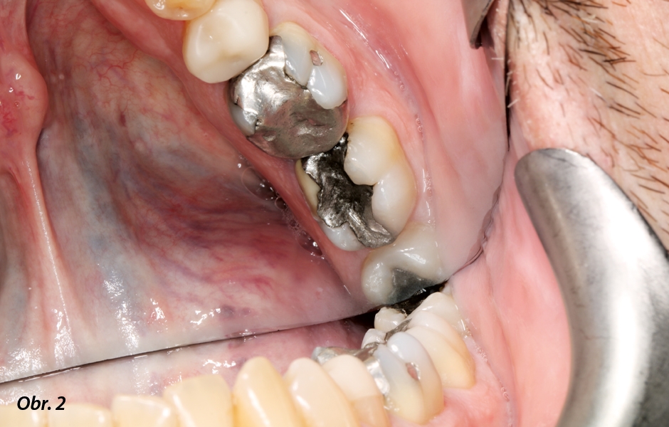 Počáteční situace v ústech pacienta.