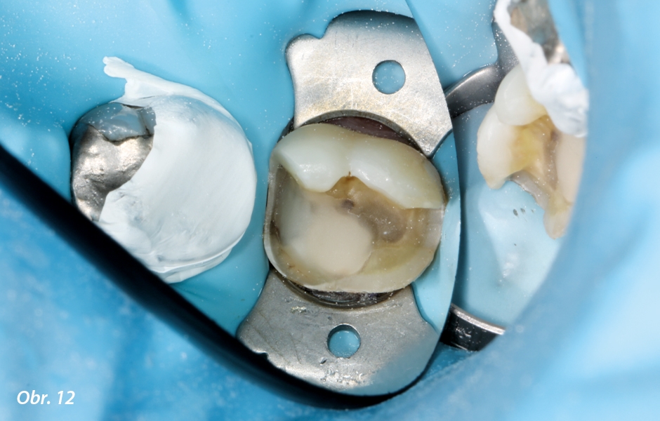 PTFE páska kvůli ochraně sousedních zubů.