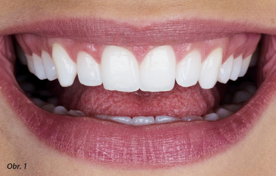 Snímek před ošetřením: pacientka požadovala hezčí horní frontální zuby