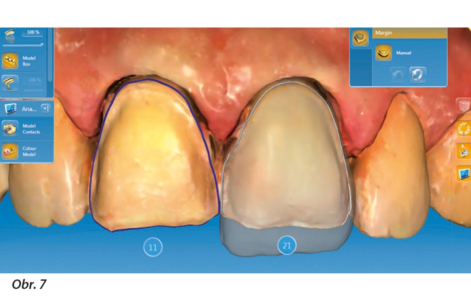 Designování hybridní keramické fazety v softwaru CEREC