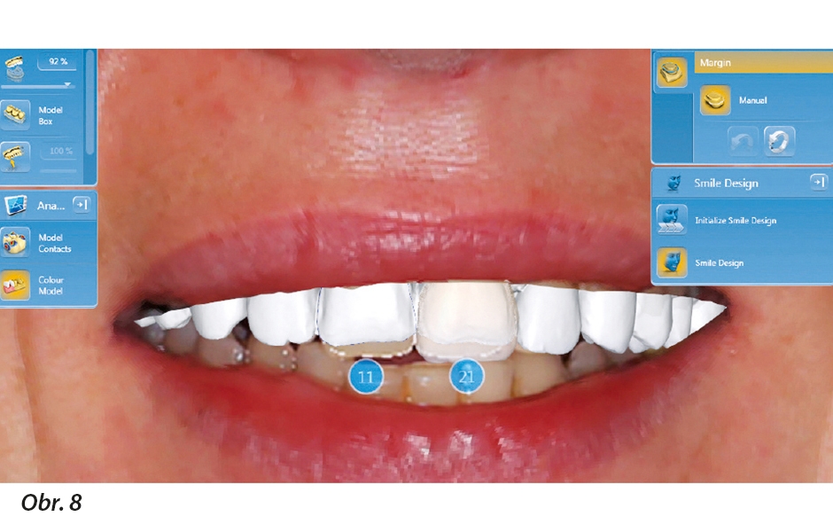 Pomocí aplikace CEREC Smile Design je možno vyhodnotit náhrady ve vztahu se rty