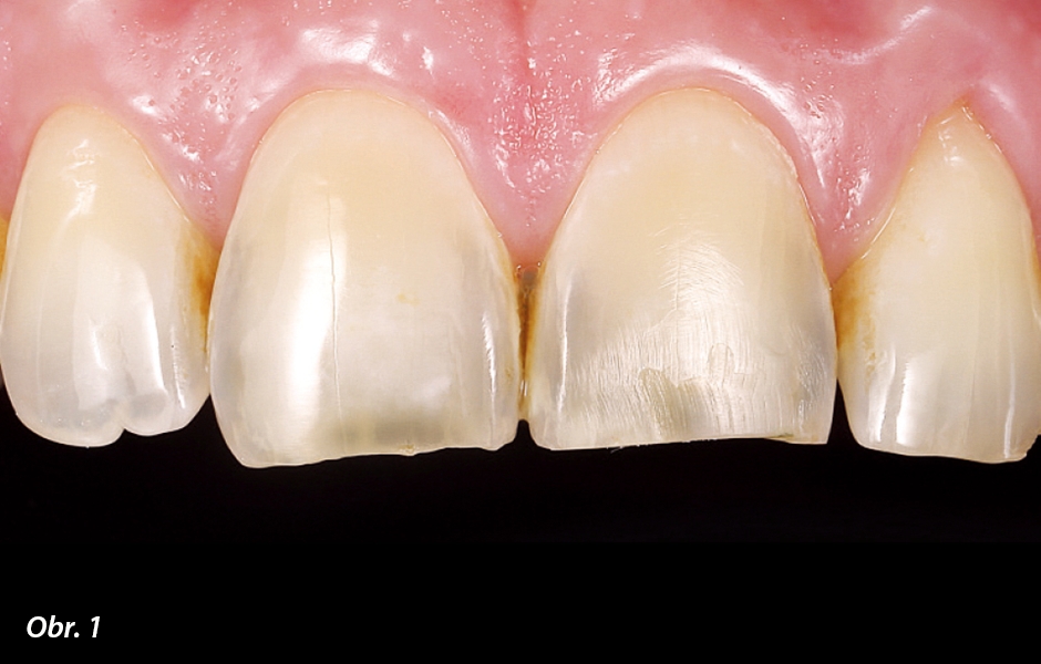 POČÁTEČNÍ SITUACE – Eroze a abraze vedla ke zkrácení řezáku a ztrátě morfologie zubů 11 a 21