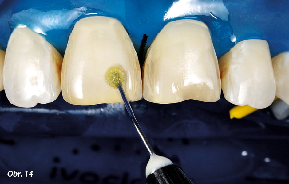 Na povrchy zubů bylo naneseno světlem tuhnoucí jednosložkové adhezivum