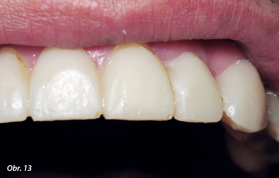 Povrch zubu 21 po zaplnění defektu