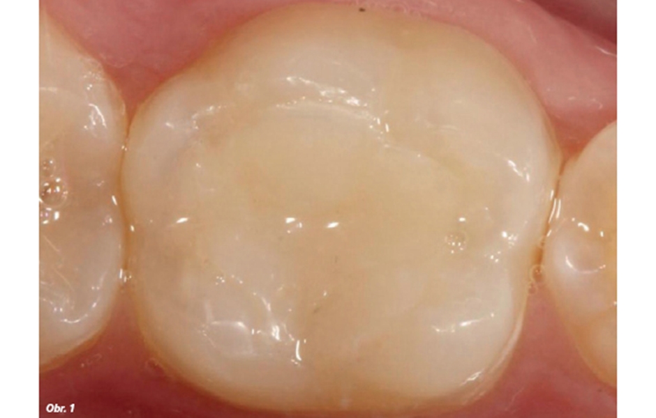 Preoperační pohled zubu 36