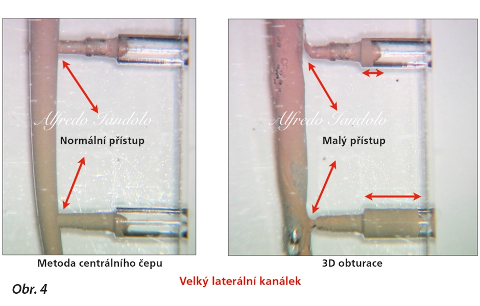 Test in vitro ukazující lepší pronikání sealeru do laterálního kanálku