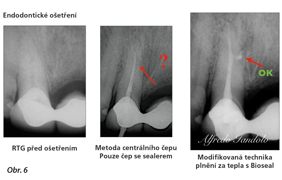 Endodontické ošetření zubu 11