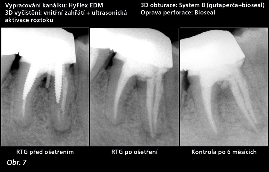 Reendodontické ošetření zubu 46 spojené s periapikálními lézemi souvisejícími s meziálními a distálními kořeny a furkační lézí