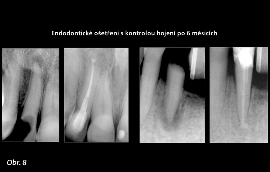 Endodontická ošetření s hojením a následným sledováním po šesti měsících: 3D obturace byla dosažena za použití modifikované techniky plnění za tepla