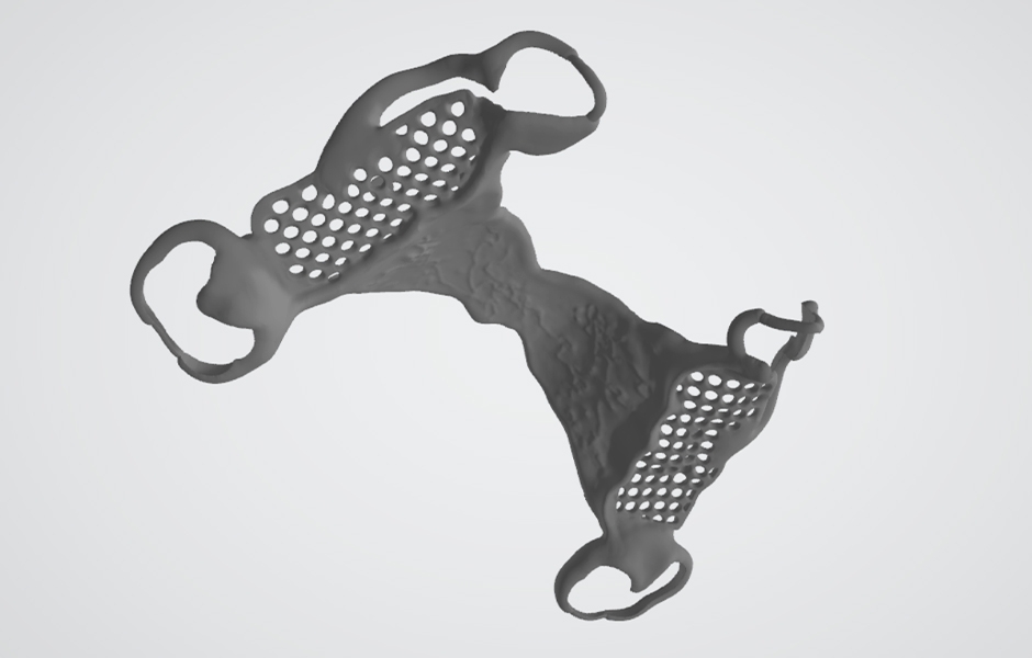Obr. 4: STL soubor CAD návrhu pro CAM výrobu skeletu 3D tiskem – syntrováním CrCo.