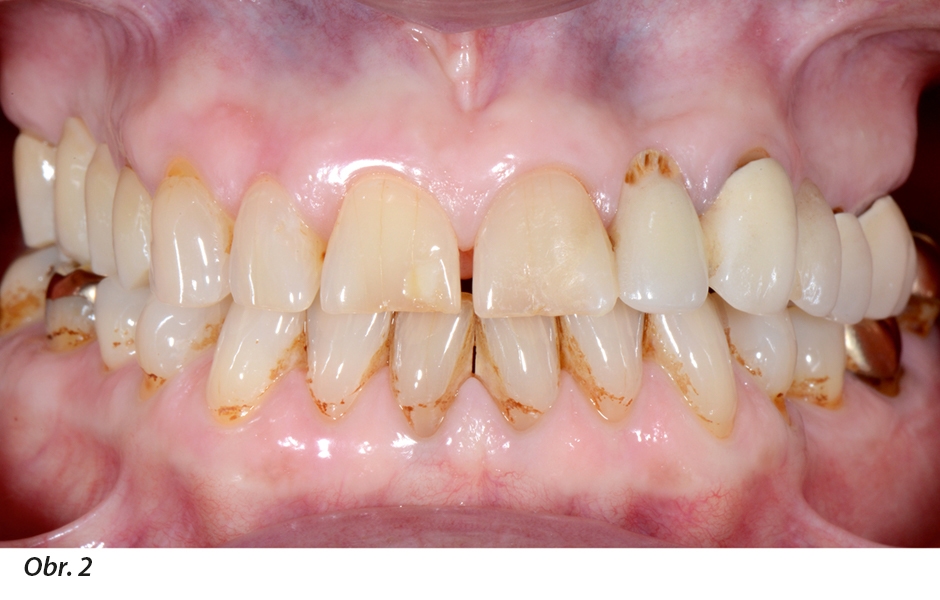 Intraorální frontální pohled před hygienickou fází. Extrémní nánosy zubního plaku v důsledku kuřáckých návyků pacienta. Nepříznivý poměr výšky a šířky na korunce 22 je jasně patrný.