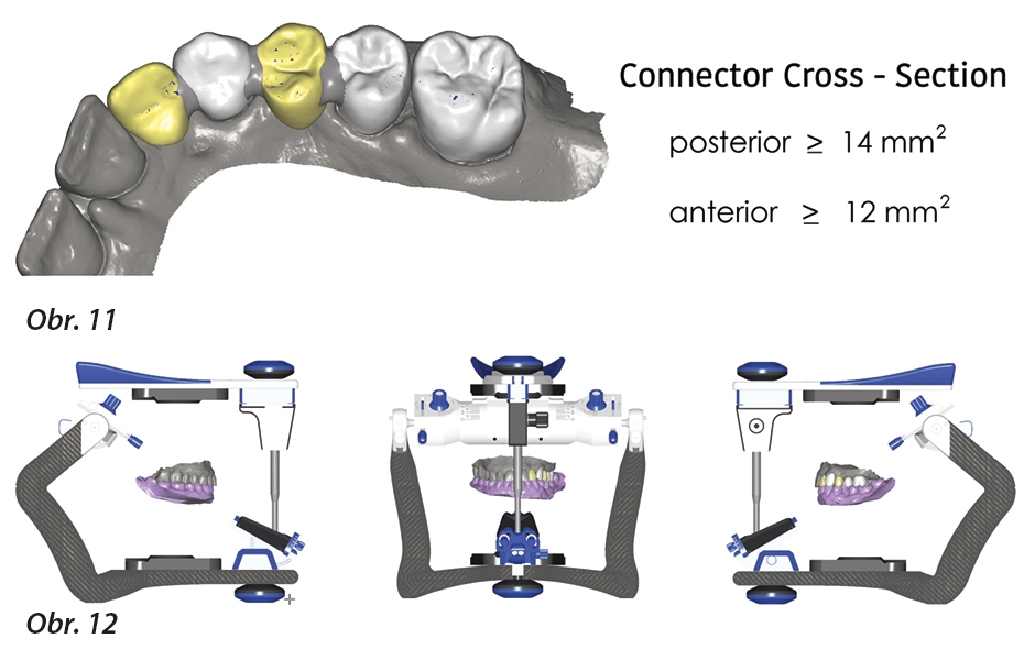 Minimální tloušťka můstkových spojů ve frontální a distální oblasti pro náhrady z oxidu zirkoničitého Lava Esthetic + Digitální artikulátor umožňuje verifi kaci a virtuální zabroušení kontaktů statické a dynamické okluze