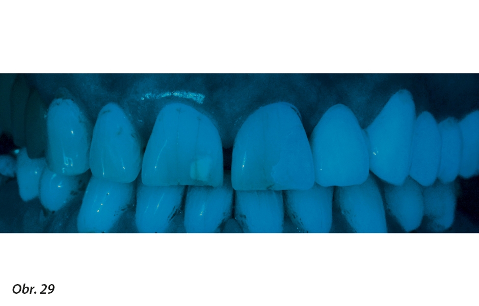 Pod černým světlem vykazovala fluorescence materiálu intenzivnější fluorescenci než přirozené sousední zuby. Zřetelné jsou také defekty v mineralizaci na zubu 11.
