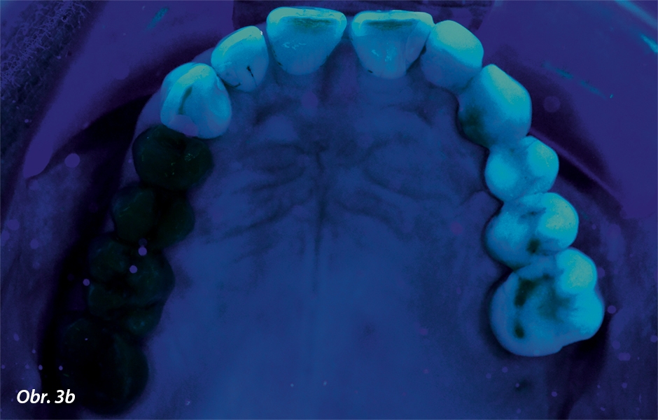 Okluzální pohled na výchozí situaci: Fotografováno pod černým světlem (Fluor Eyes filter): Jsou zde patrné fluorescenční vlastnosti fazetované keramiky metalokeramického můstku ve druhém kvadrantu