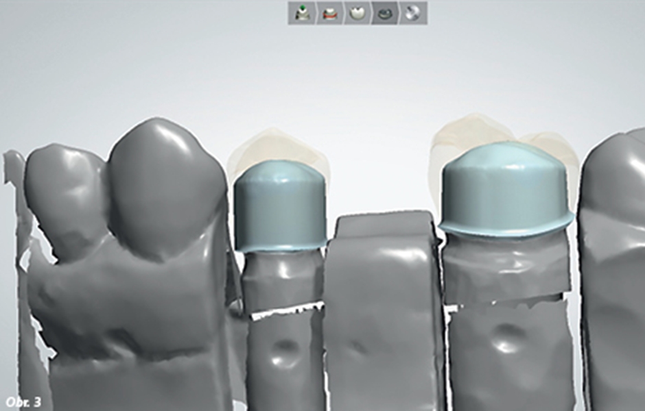 Úprava tvaru/frikce primárních korunek pomocí CAD software