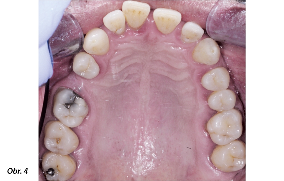Fotografická dokumentace počátečního stavu před parodontologickým ošetřením