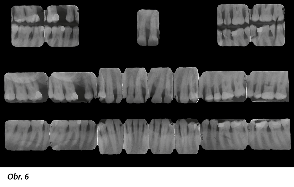 RTG snímky celých úst: 60% úbytek kosti (vertikálně i horizontálně)