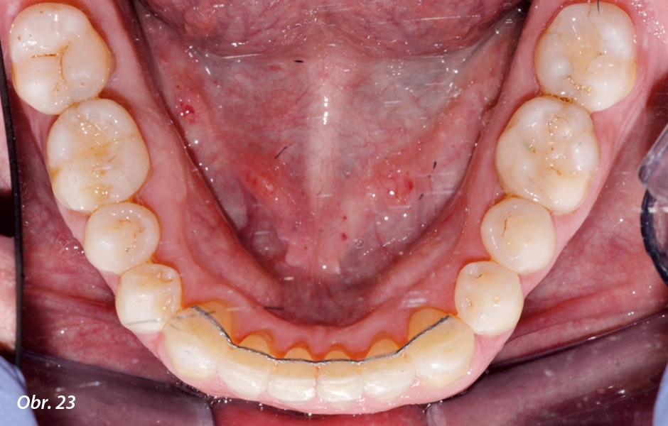 V rozsahu od zubu 14 po zub 24 a od zubu 33 po zub 43 byl použit bondovaný retainer