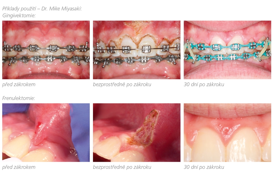 Mýty a fakta o použití laseru v zubní ordinaci<br>Rozhovor s Dr. Sergiem Velasquezem 