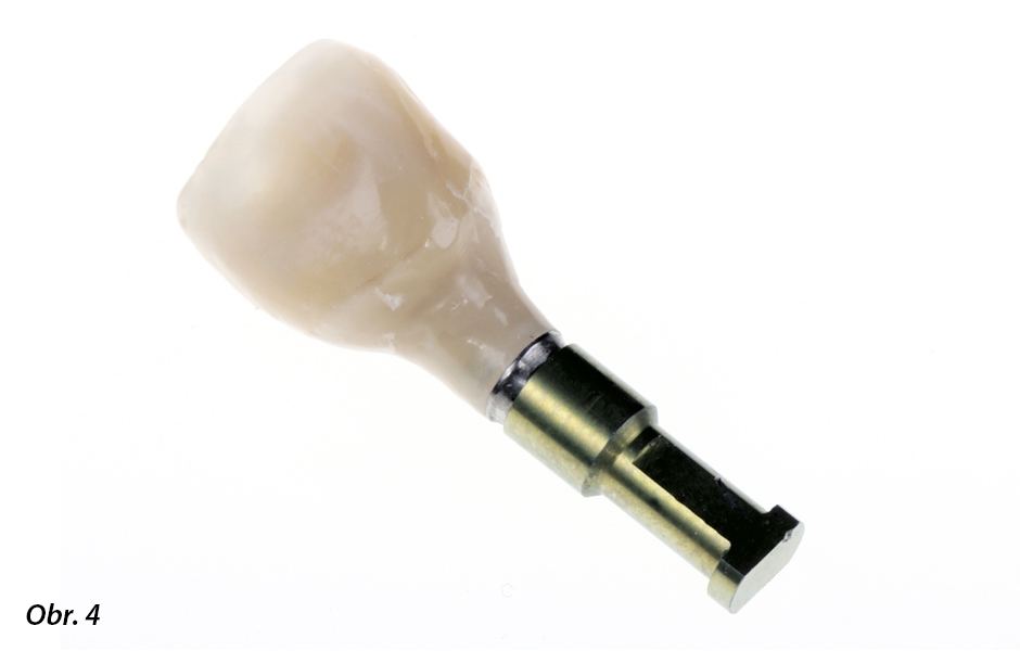 Provizorní korunka, vyjmutá z úst pacientky, s individualizovaným emergence profilem byla očištěna a našroubována na kompatibilní laboratorní analog