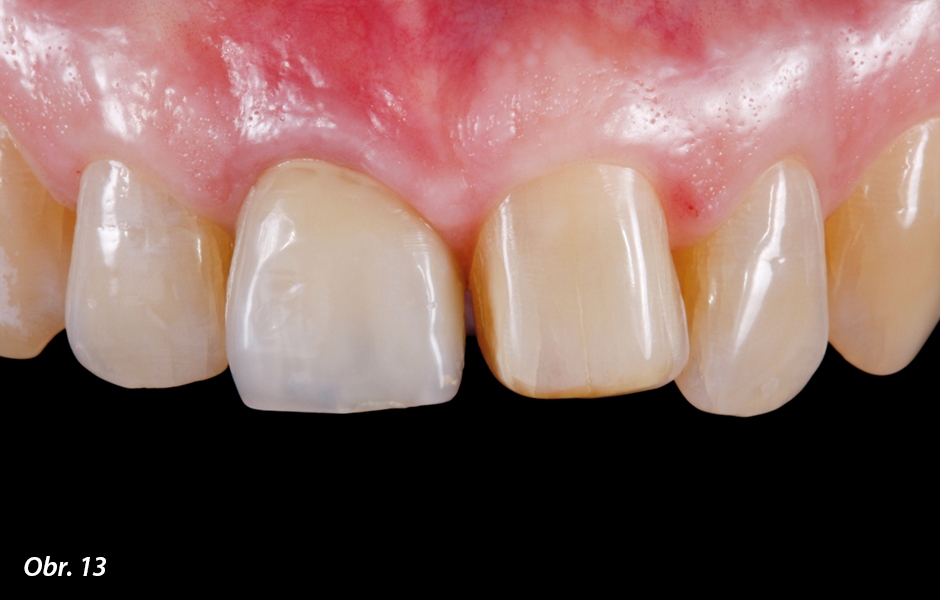 Dokončená preparace na fazetu s incizálním schůdkem za účelem prodloužení zubu pomocí keramické fazety