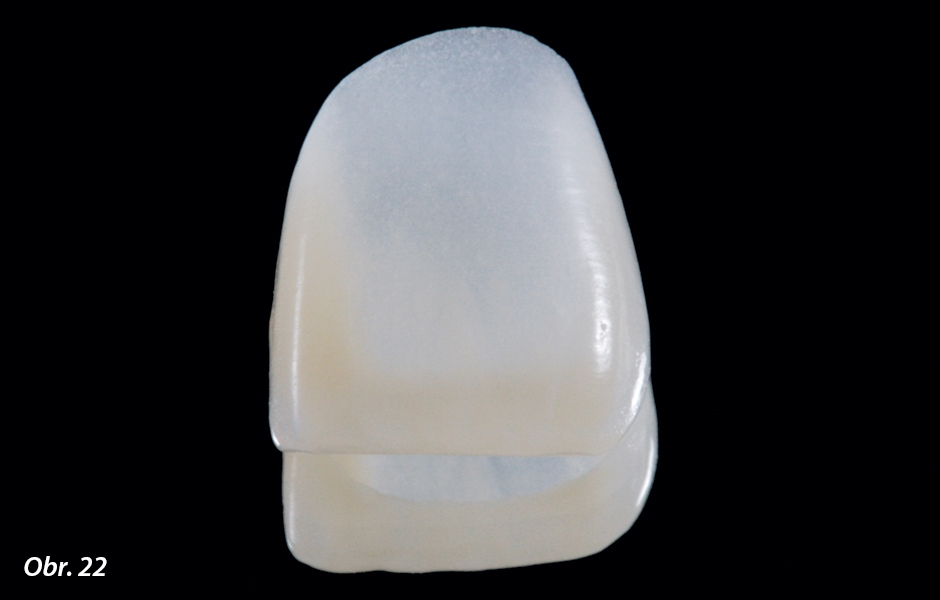 Vzhledem k tenké a translucentní vrstvě si lze jasně povšimnout, že výsledná barva nasazené keramické fazety je v tomto případě závislá především na barvě napreparovaného zubního pahýlu
