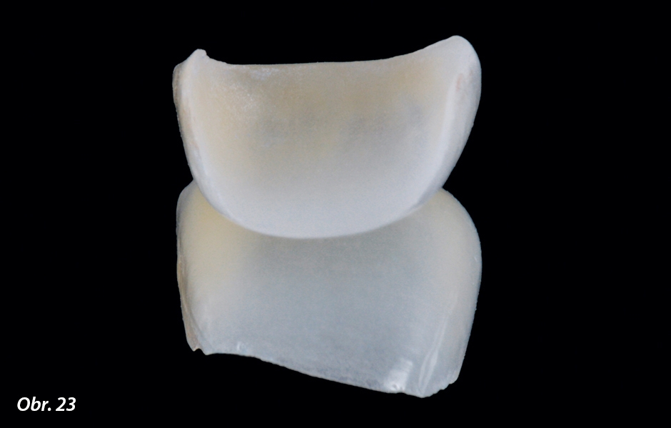 Vnitřní strana fazety ukazuje přechody z translucentního labiálního vrstvení keramiky do opakních incizálních a aproximálních oblastí