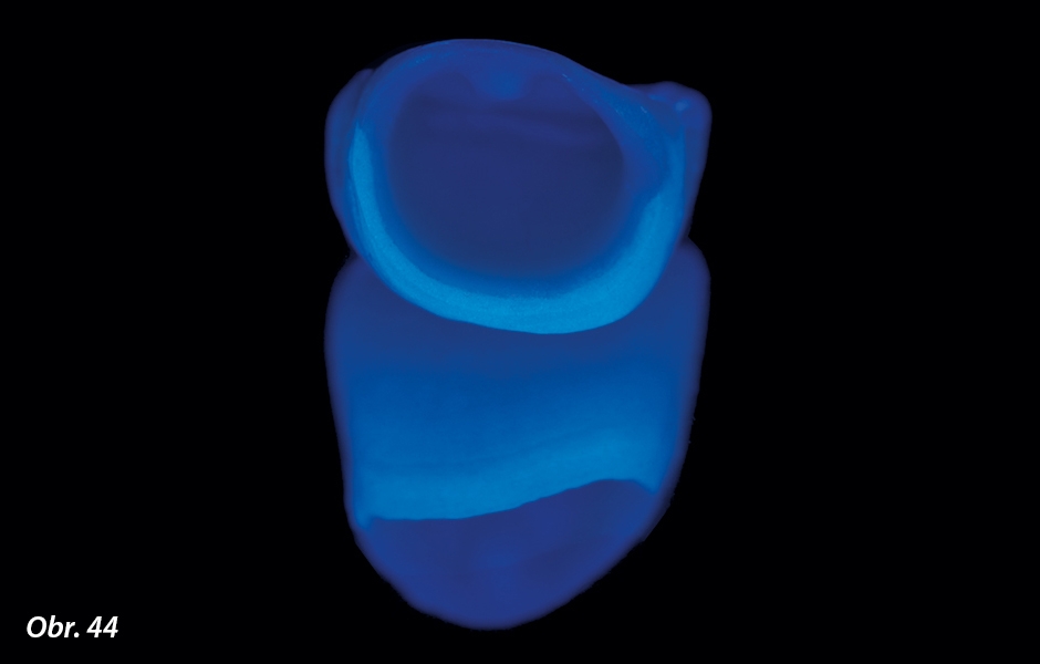  Pod UV světlem se díky fazetovací keramice objevila vynikající fluorescence i na okraji definitivní korunky