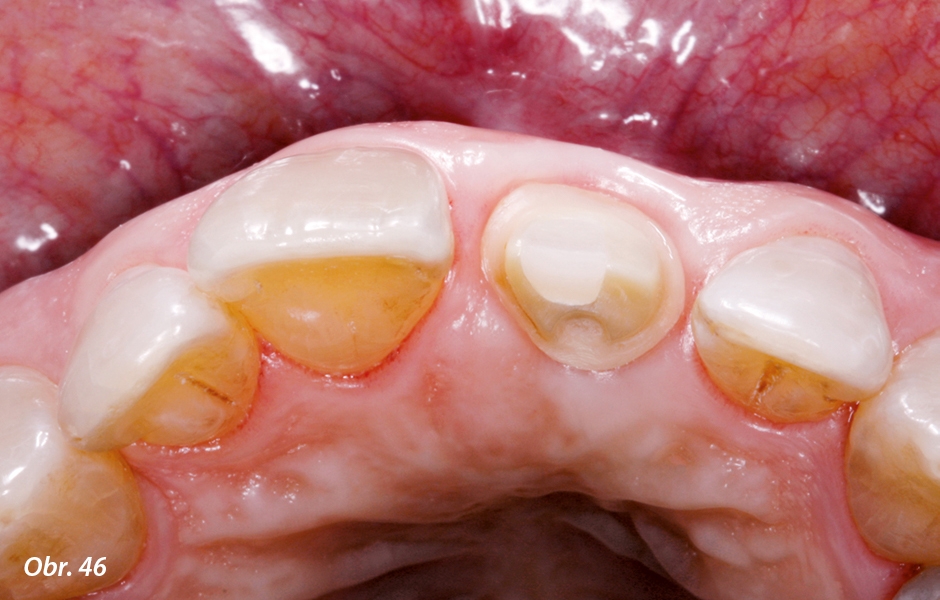 Po sejmutí provizorní korunky z implantátu se odhalila nepodrážděná marginální gingiva s perfektním podepřením měkkých tkání individuálním hybridním abutmentem jak ve vertikálním, tak i v horizontálním směru