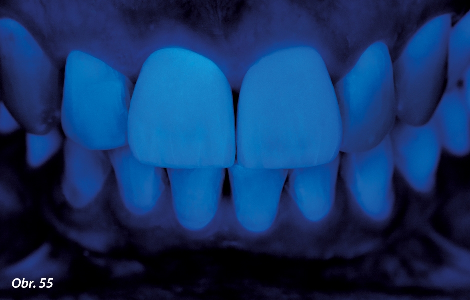 Rovněž pod UV světlem se nedá rozeznat žádný rozdíl mezi keramickými rekonstrukcemi a přirozenými zuby