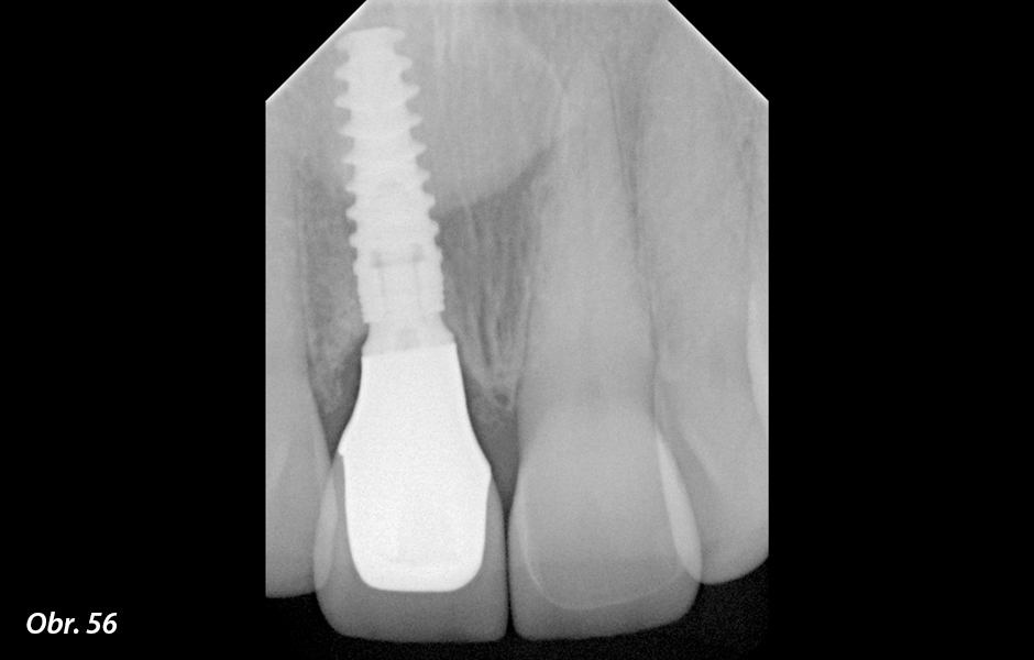 Rentgenový snímek ukazuje dobrou a stabilní oseointegraci implantátu