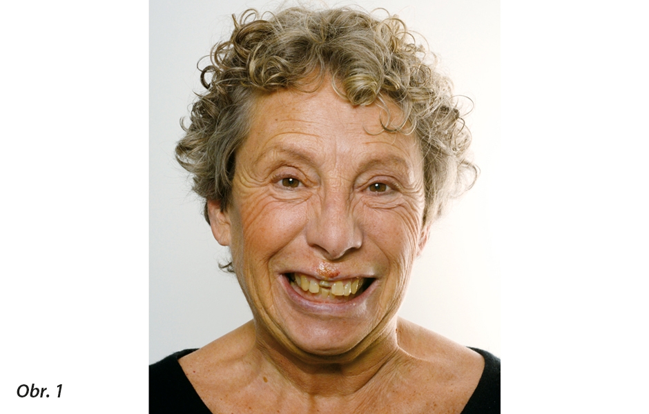 67letá pacientka po úrazu předních zubů
