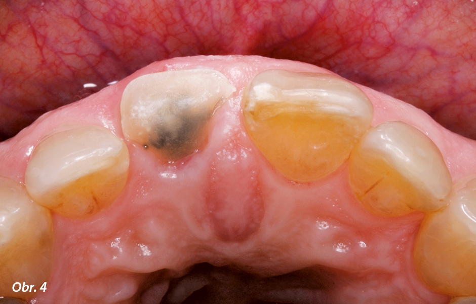 Zub 11 vykazoval komplikovanou frakturu korunky s palatinálně výrazně subgingiválně probíhající lomnou linií