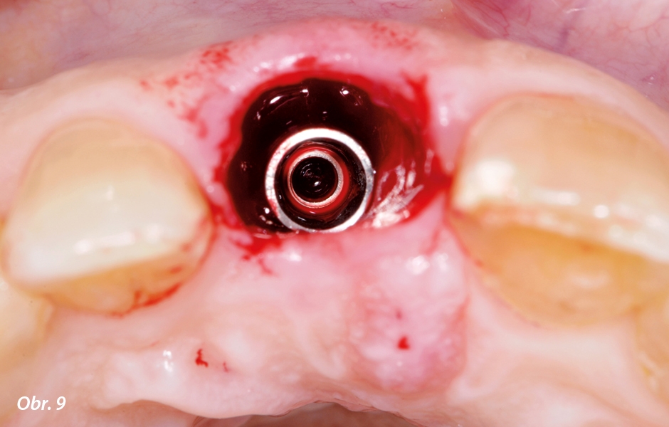 Horní okraj krčku implantátu byl ve vertikálním rozměru umístěn tři milimetry pod průběh cementosklovinné hranice zubu 21