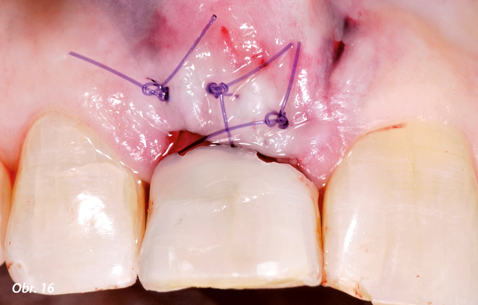 Na konci implantačního sezení byl fragment korunky přizpůsoben nově vzniklé situaci a kompozitem byl opět jako provizorium fixován na sousední zuby
