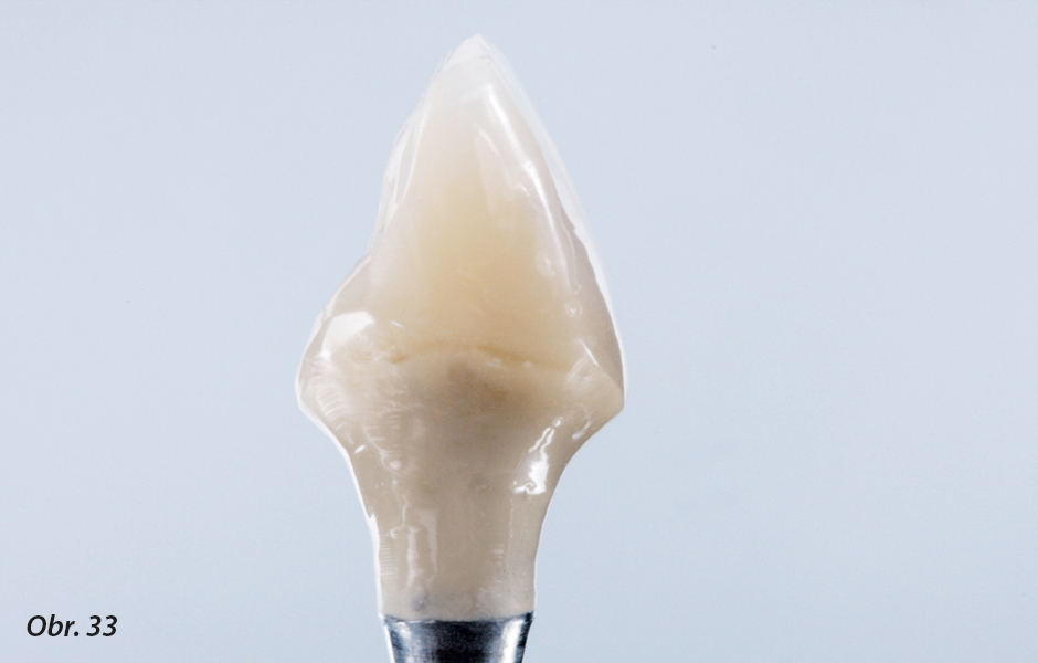 Tvar provizorní korunky v oblasti prostupu tkáněmi umožňuje tvarování periimplantárních měkkých tkání, které se vyrovnají emergence profilu přirozeného zubu