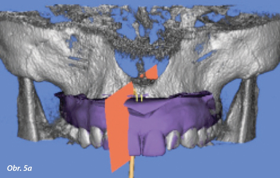 CBCT sken po šesti týdnech ukazující dehiscenci nebo alespoň nezralý substituční materiál kosti v palatinálním aspektu při ideální pozici