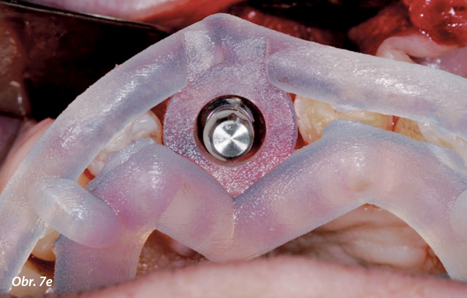 Implantát umístěný pomocí řízené inzerce