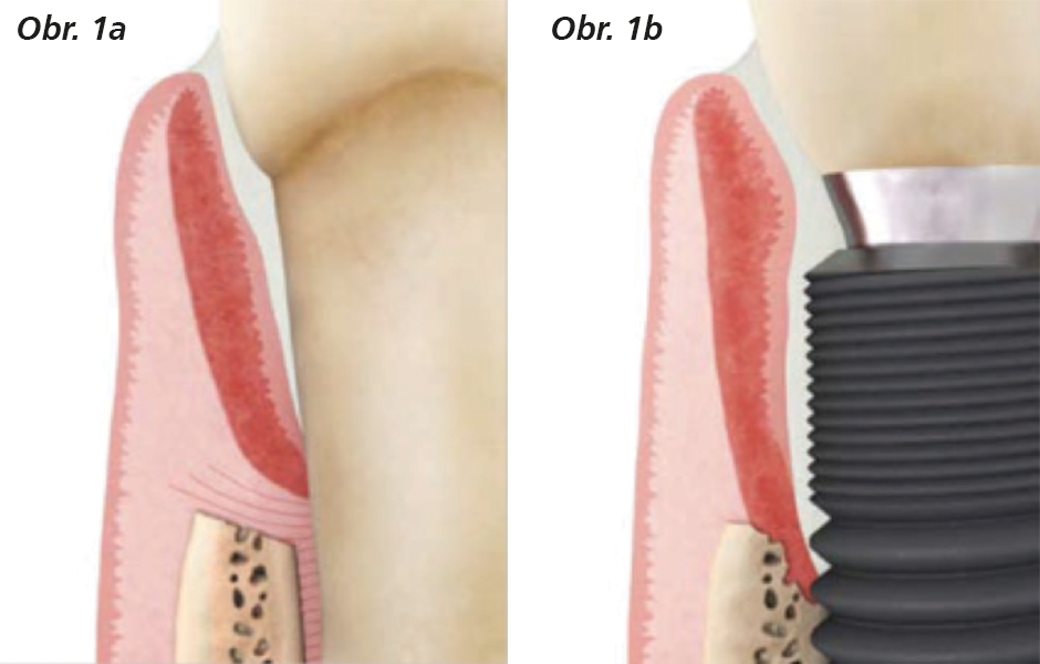 1a: Parodontitida, 1b: Periimplantitida