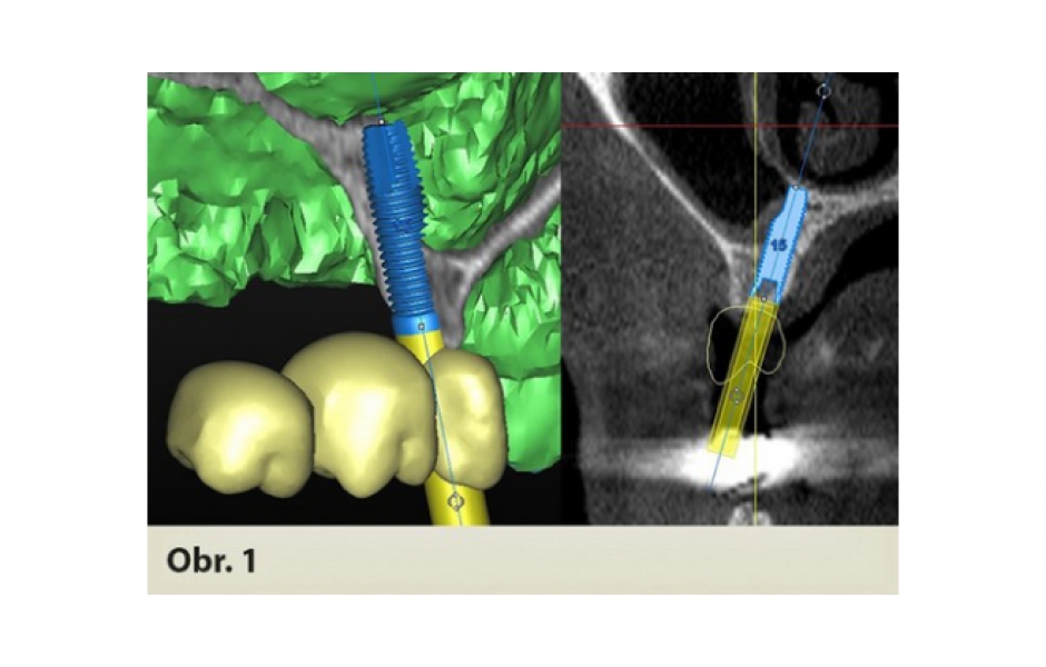 Navigovaná implantace do tenké čelisti