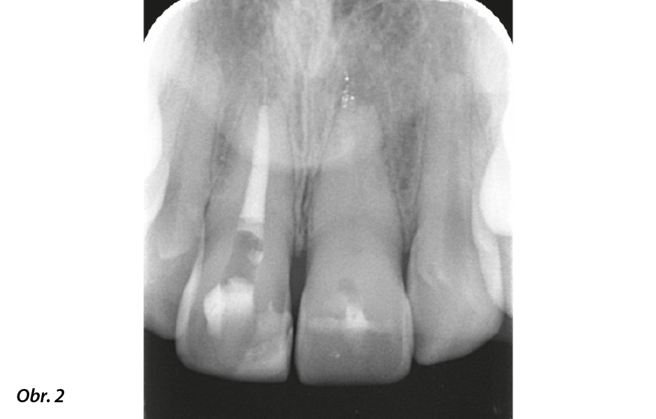 Předoperační rentgenový snímek ukazující těžkou kalcifi kaci systému kořenových kanálků zubu 21.