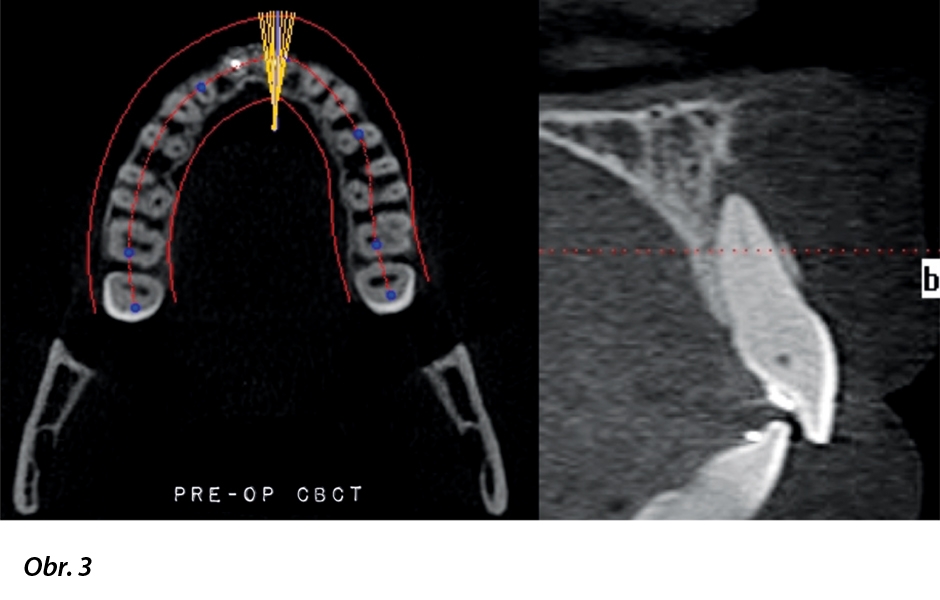 CBCT snímek ukazuje těžkou kalcifi kaci kořenového kanálku a apikální obraz odpovídající apikální periodontitis.