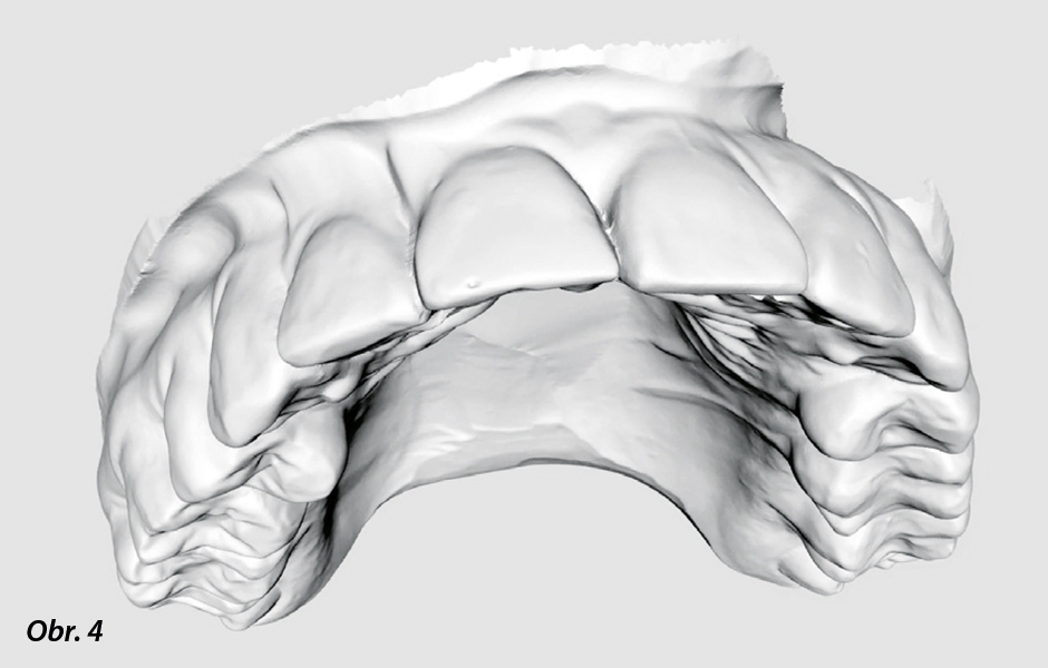 3D virtuální zubní model naskenovaný iTero.